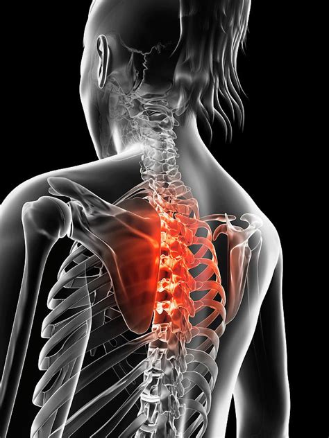 Human Thoracic Spine Pain Photograph By Sebastian Kaulitzki
