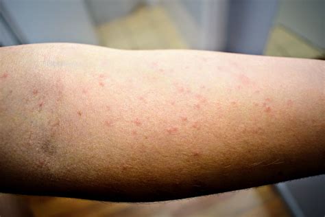 What Do Scabies Look Like On Human Skin Images And Photos Finder