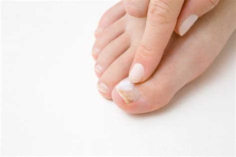 What Causes Yellow Crumbly Nails Jennifer Tauber Dpm Podiatrist
