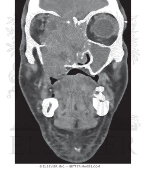 Coronal Ct Reconstruction With A Soft Tissue Window Showing A Large