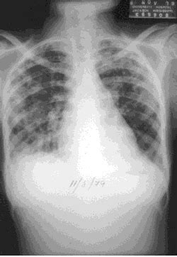 La embolia pulmonar se produce cuando un coágulo de sangre se aloja en una arteria pulmonar y bloquea el flujo de sangre hacia una parte del pulmón. EL RINCÓN DE LA MEDICINA INTERNA: INFECCIONES PULMONARES ...