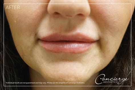 Before And After Photos Juvéderm Volbella Lips Concierge Aesthetics
