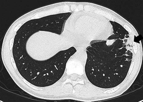 Ct Showed Subpleural Wedge Shaped Consolidation In The Area That Was