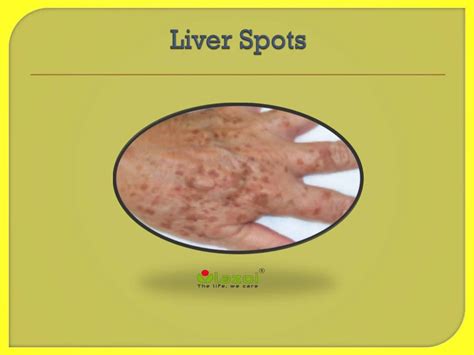 Liver Spots On Arms Photos
