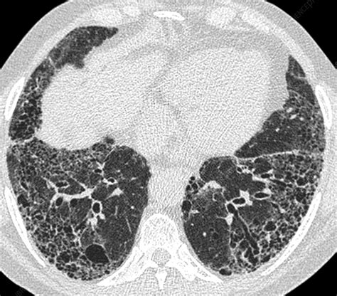 Interstitial Pneumonia Axial Chest Ct Scan Stock Image C0486241