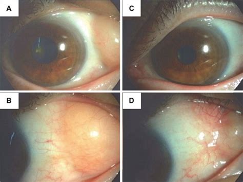 Full Article Surgical Repair Of Orbital Fat Prolapse By Conjunctival Fixation To The Sclera