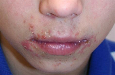 Treatments For Impetigo Are These Really Good Health Cautions