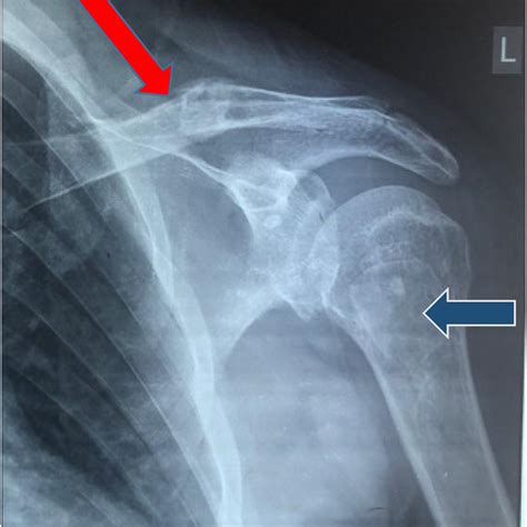 Left Shoulder Xray Showing The Fractured Clavicle Red Arrow And A