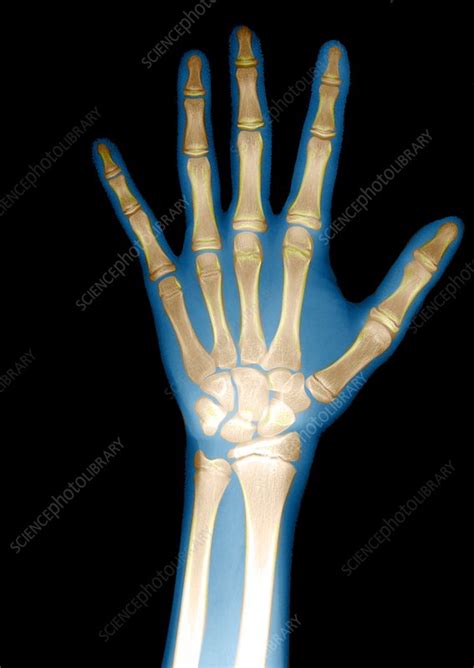 Childs Hand X Ray Stock Image M4150623 Science Photo Library