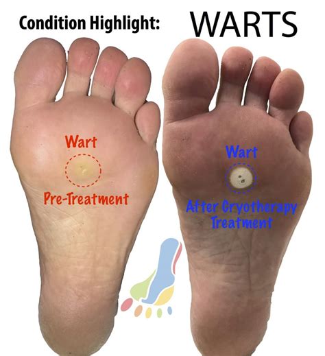 Podiatrist Treatment For Foot Warts Or Plantar Verrucae