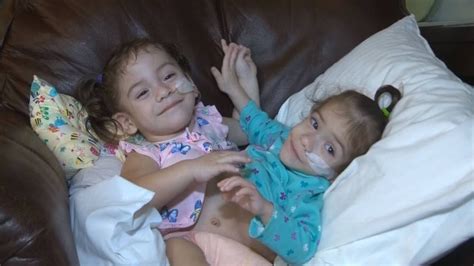 Conjoined Twins Successfully Separated Youtube