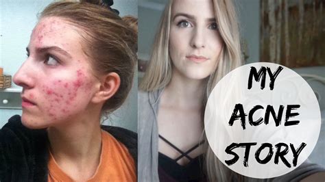 My Acne Story How I Cleared My Skin And Pictures Youtube