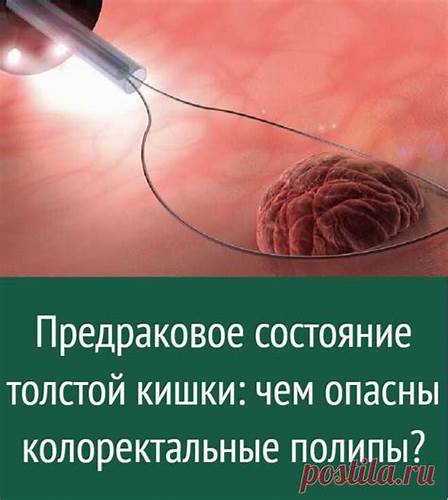 Полип толстой кишки диета Предраковое состояние толстой кишки: чем опасны колоректальные полип Предраковое состояние толстой кишки: чем опасны колоректальные полип Полип толстой кишки диета