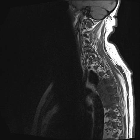 Lymphoma Of The Spine Radiology Case