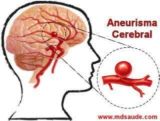 Aneurisma Cerebral Sintomas Tratamentos E Causas Grey S Anatomy Amino