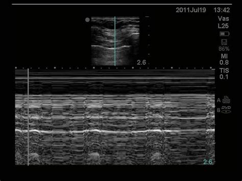Ein pneumothorax (gelber pfeil) mit noch geringer. Thoracentesis, Pleural Biopsy, and Thoracic Ultrasound