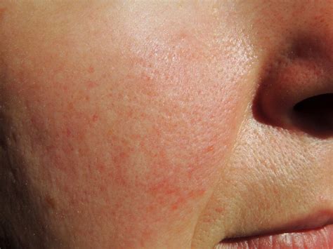 Acne Rosacea Treatment 6 Reasons Not To Wait Dermatology Consultants