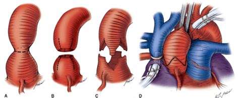 Surgery For Left Ventricular Outflow Tract Obstruction In Children
