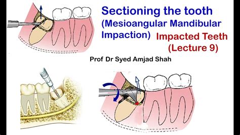 Sectioning Cutting The Tooth Mesioangular Mandibular Third Molar