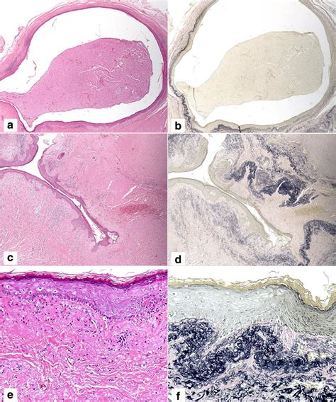 Histopathological Features Of The Intraoral Epidermoid Cyst Showing