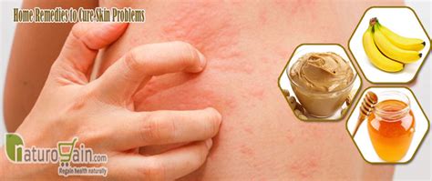 9 Best Home Remedies For Skin Irritation To Prevent Rashes