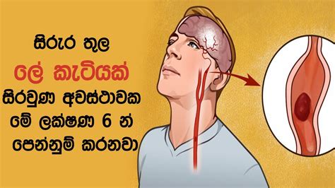 සිරුර තුල ලේ කැටියක් සිරවුණ අවස්ථාවක මේ ලක්ෂණ 6 න් පෙන්නුම් කරනවා Youtube