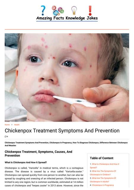 Chickenpox Treatment Symptoms And Prevention