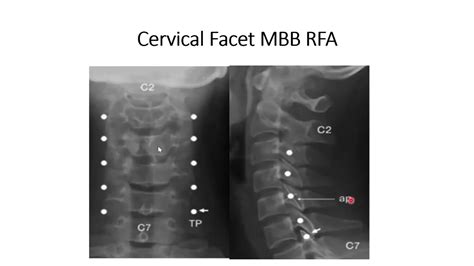 Cervical Facet Joint Median Branch Radiofrequency Ablation A Stepwise Approach YouTube