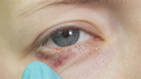 Eczema On Eyelids Medovie Your Journey For Healthy Skin Starts Here