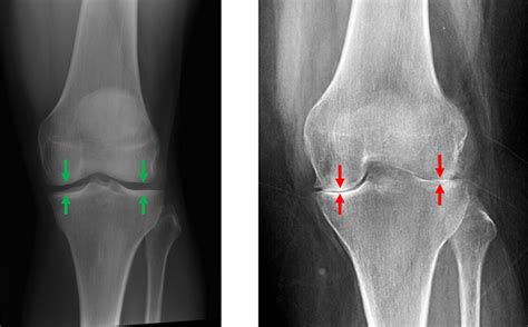 Types And Symptoms Of Knee Arthritis David Slattery