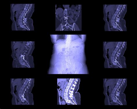 What Is A Lumbar Spine Ct Scan Two Views