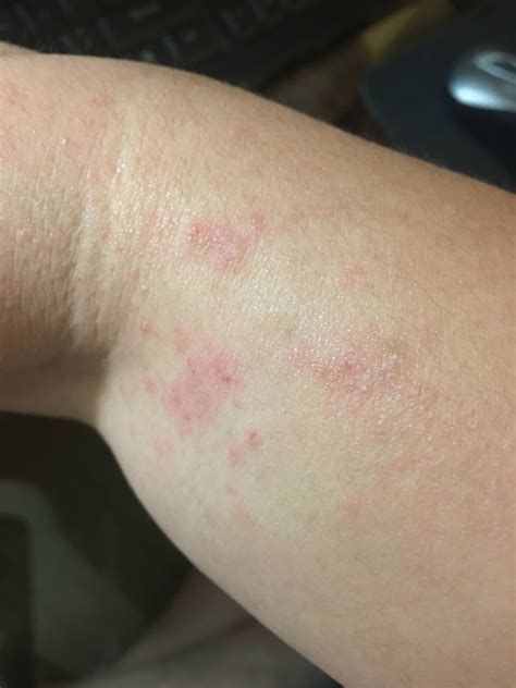Itchy Scaly Bumpy Patches On Skin Wpics Sherdog Doctor Brahs Gtfih