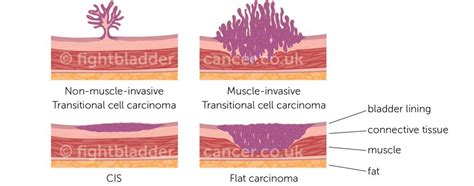 Types And Stages Of Bladder Cancer Fight Bladder Cancer