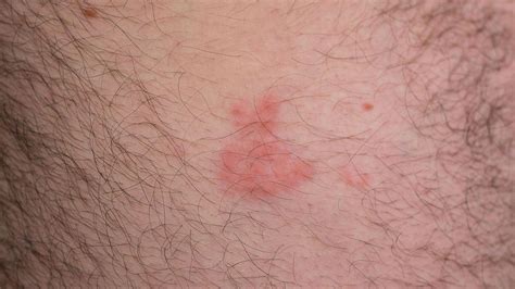 The Early Stages Of Shingles Signs And Symptoms