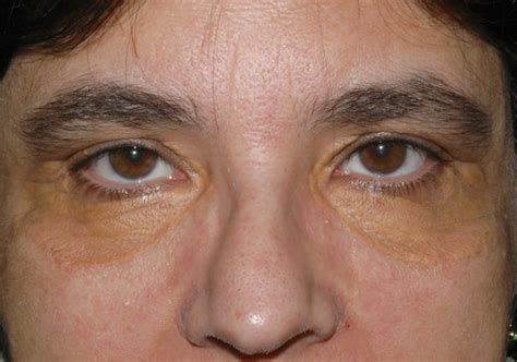 Xanthoma Eye Tendinous Tuberous And Disseminatum Causes And Treatment
