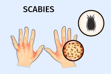 Scabies Causes Symptoms Treatment Complications