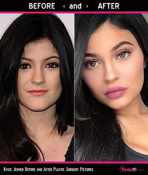 old kylie jenner lips and faces plastic surgery before and after pic 10 kylie jenner lips