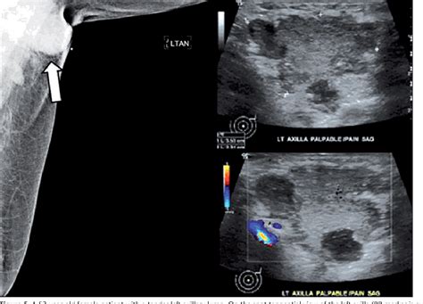 Figure 5 From Abnormal Axillary Lymph Nodes On Negative Mammograms
