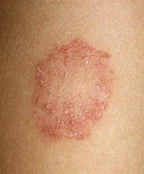 Ringworm Daad Skin Infection Treatment Clinic In Bhopal