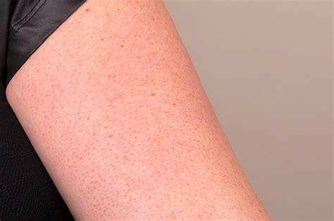 Bumpy Redhead Skin It May Be Keratosis Pilaris This Is How To Treat It