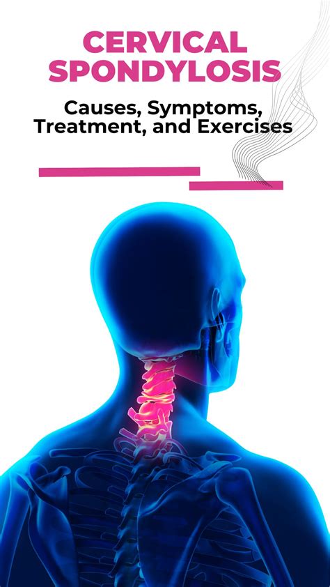 Cervical Spondylosis Causes Symptoms Treatment We Are Spine