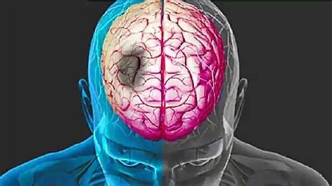 80 Of Brain Stroke Patients Reach Hospital Late Says Study Punjab