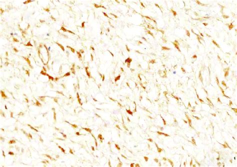 Beta Catenin Immunohistochemical Stain Shows Nuclear Staining