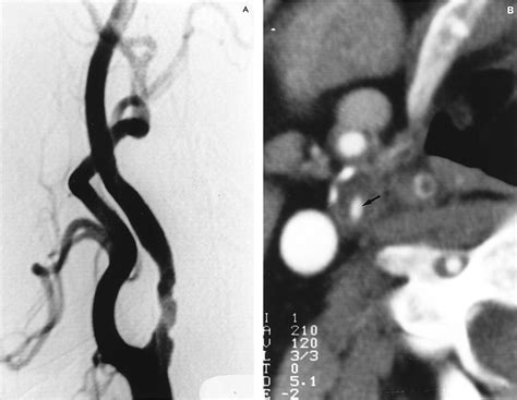 Computed Tomographic Angiography For The Evaluation Of Carotid Artery