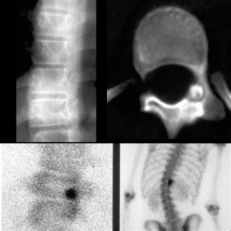 Osteoid Osteoma Of The Spine Pacs