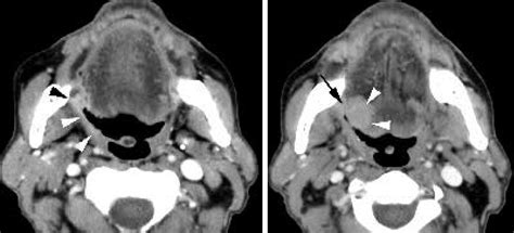 Figure 1 Axial Contrast Enhanced Ct Images In A Patient With Right