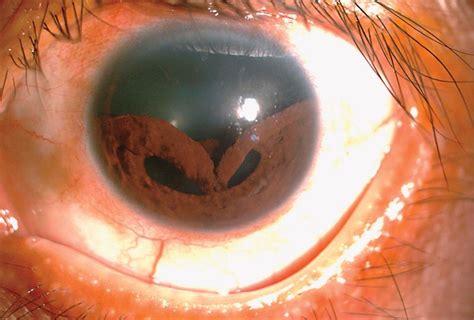 An Odd Eye Injury Caused A Mans Iris To Collapse Live Science