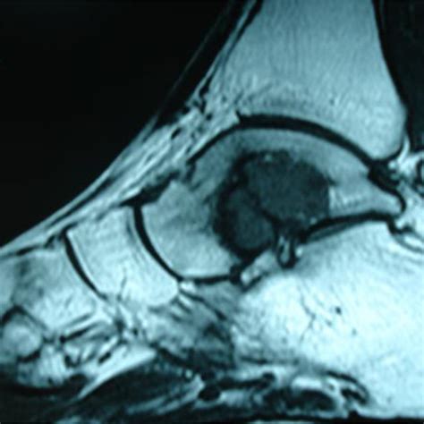 Preoperative Lateral X Ray View Of Giant Cell Tumor Of Calcaneus