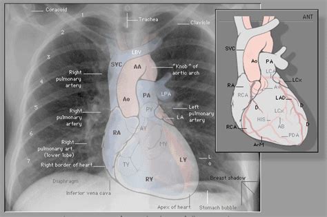 Anatomy Of Chest X Ray Normal Chest X Ray • Litfl Medical Blog