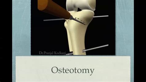 Dome Osteotomy For Knee Osteoarthrosis Youtube